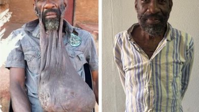 Successful surgery frees a man from a decade-long keloid